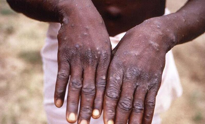 LI ABD'YÊ WEQAYA EWİL YA VÎRÛSA MONKEYPOX YA 2022'AN HAT TESPÎTKIRIN